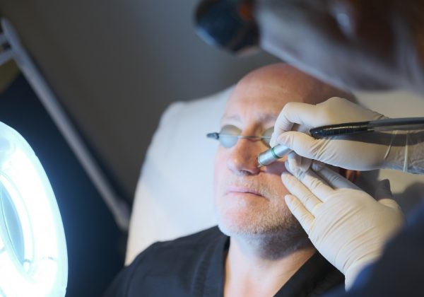 Thread Vein Removal (Face & Leg)
