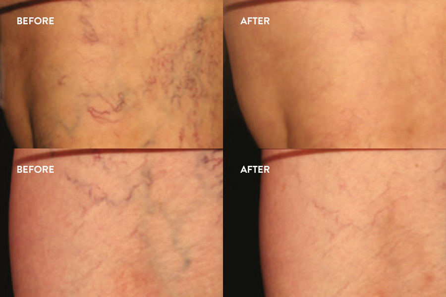 Leg Spider Veins & Thread Vein Removal